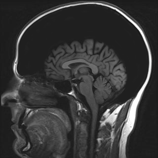 mike mri